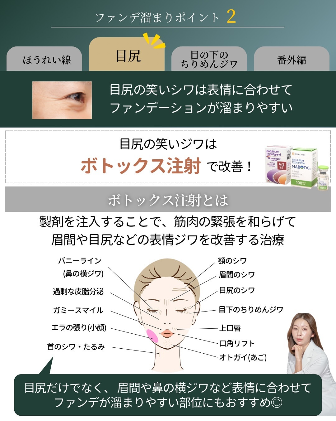 目尻の笑いジワはボトックス注射