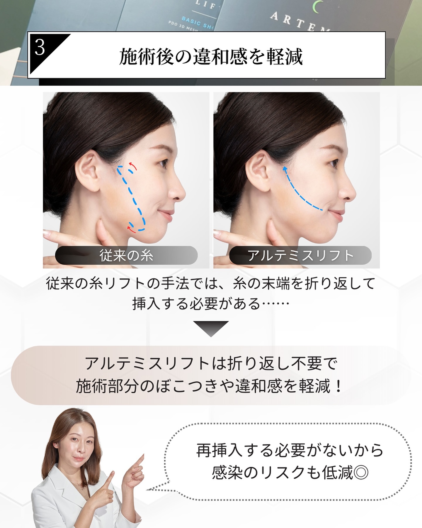 アルテミスリフトの施術後