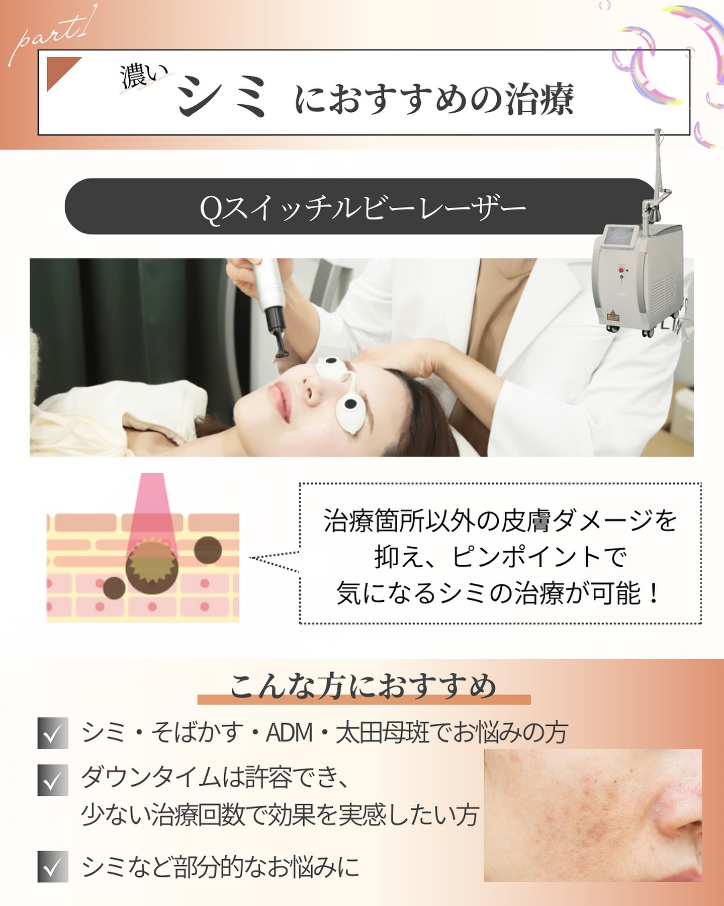Qスイッチルビーレーザーを受ける女性の写真と施術内容