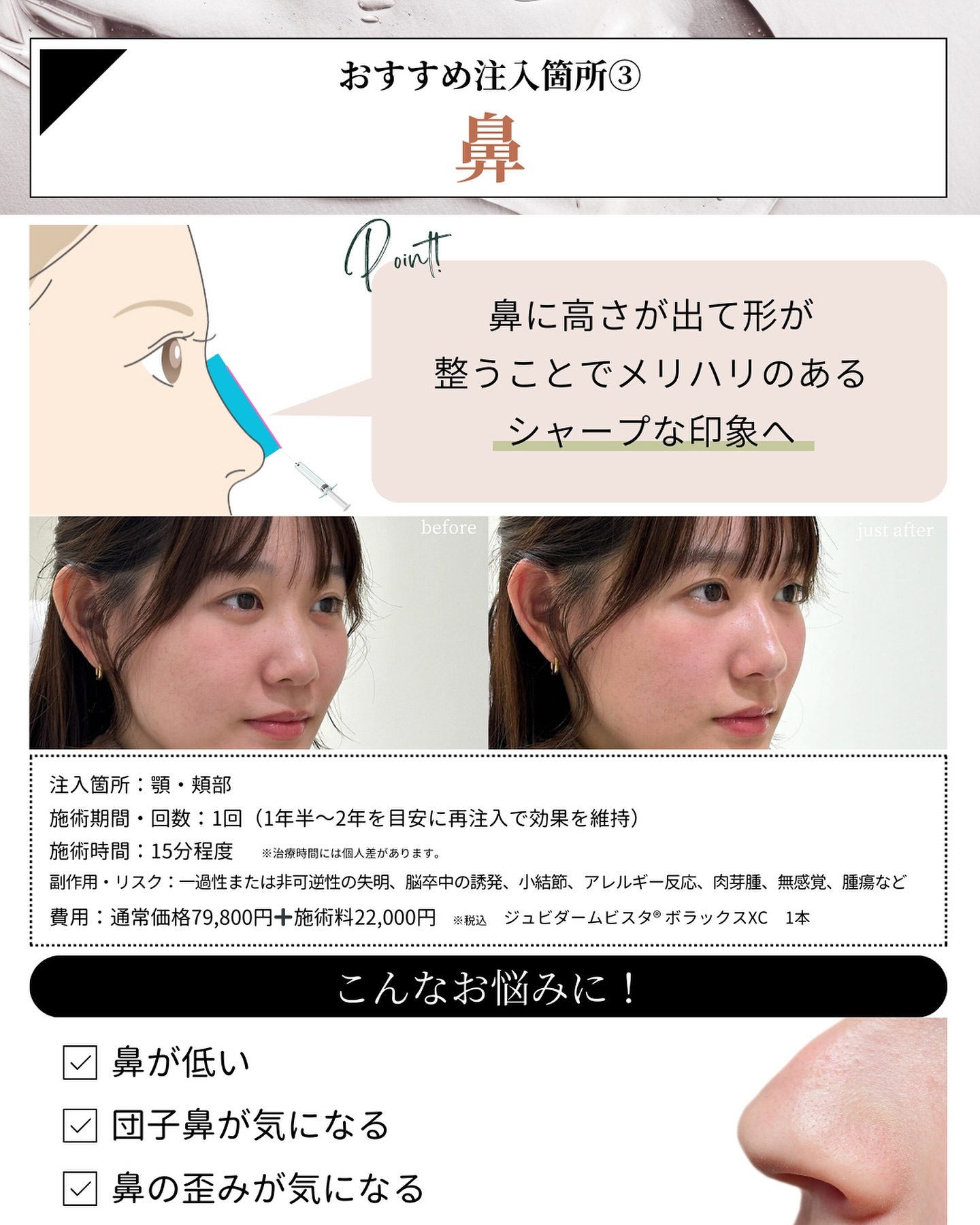 ヒアルロン酸注入 鼻
