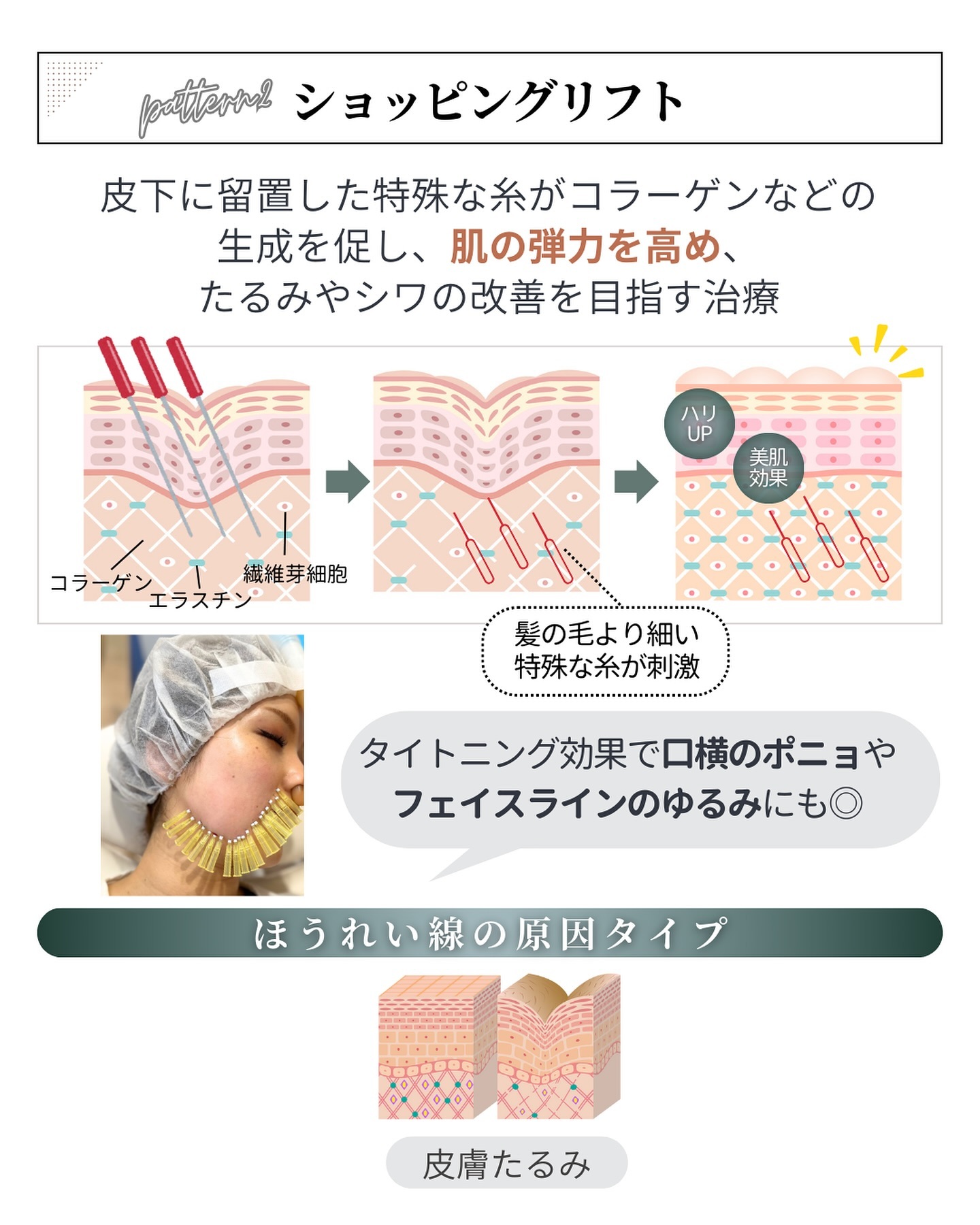 ほうれい線治療「ショッピングリフト」の仕組み