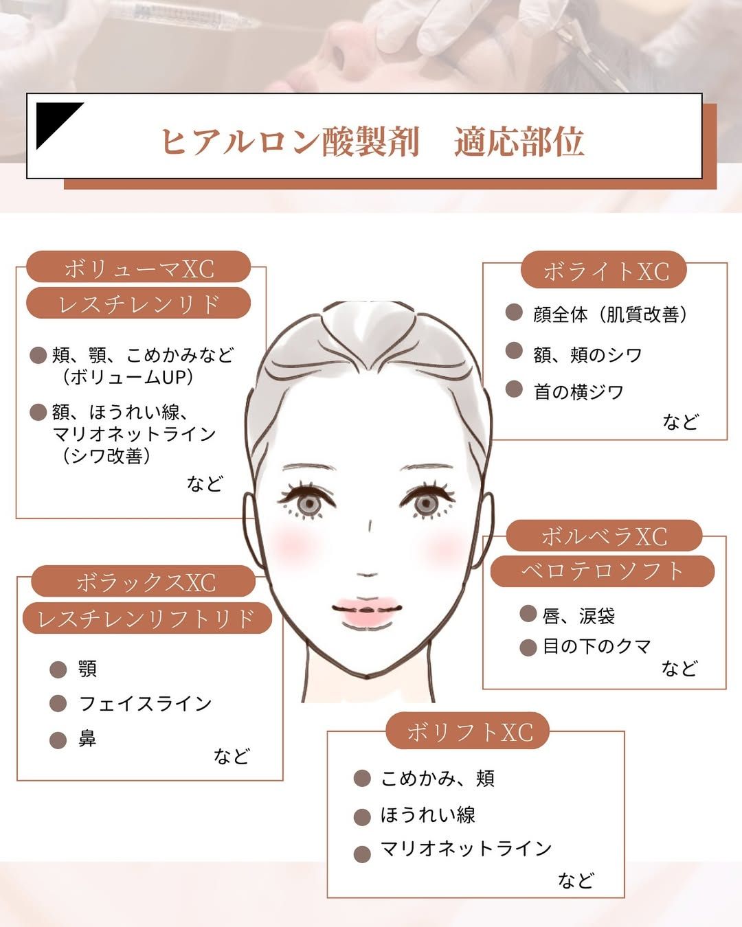 ヒアルロン酸製剤の適応部位