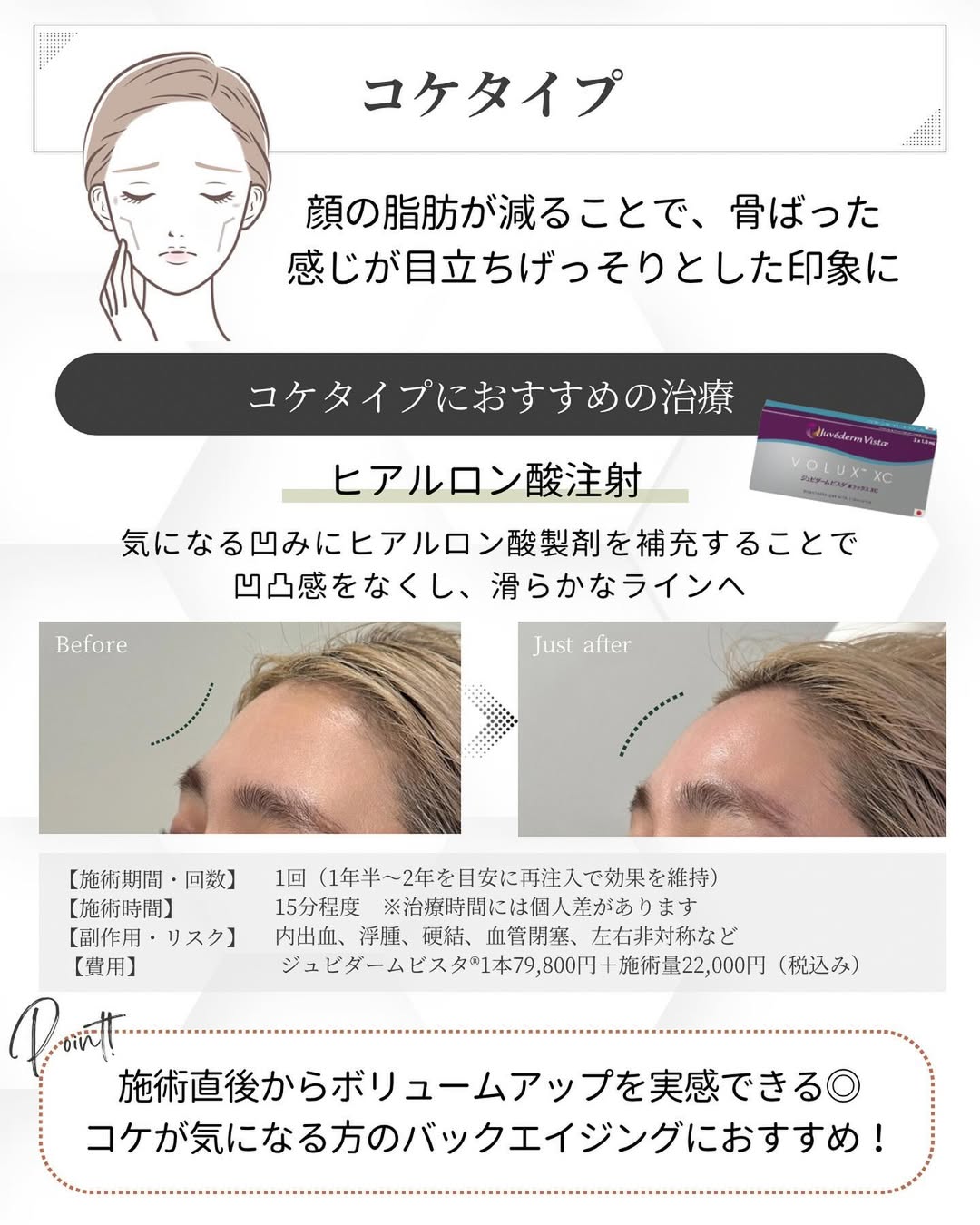 コケタイプにおすすめの治療「ヒアルロン酸注射」