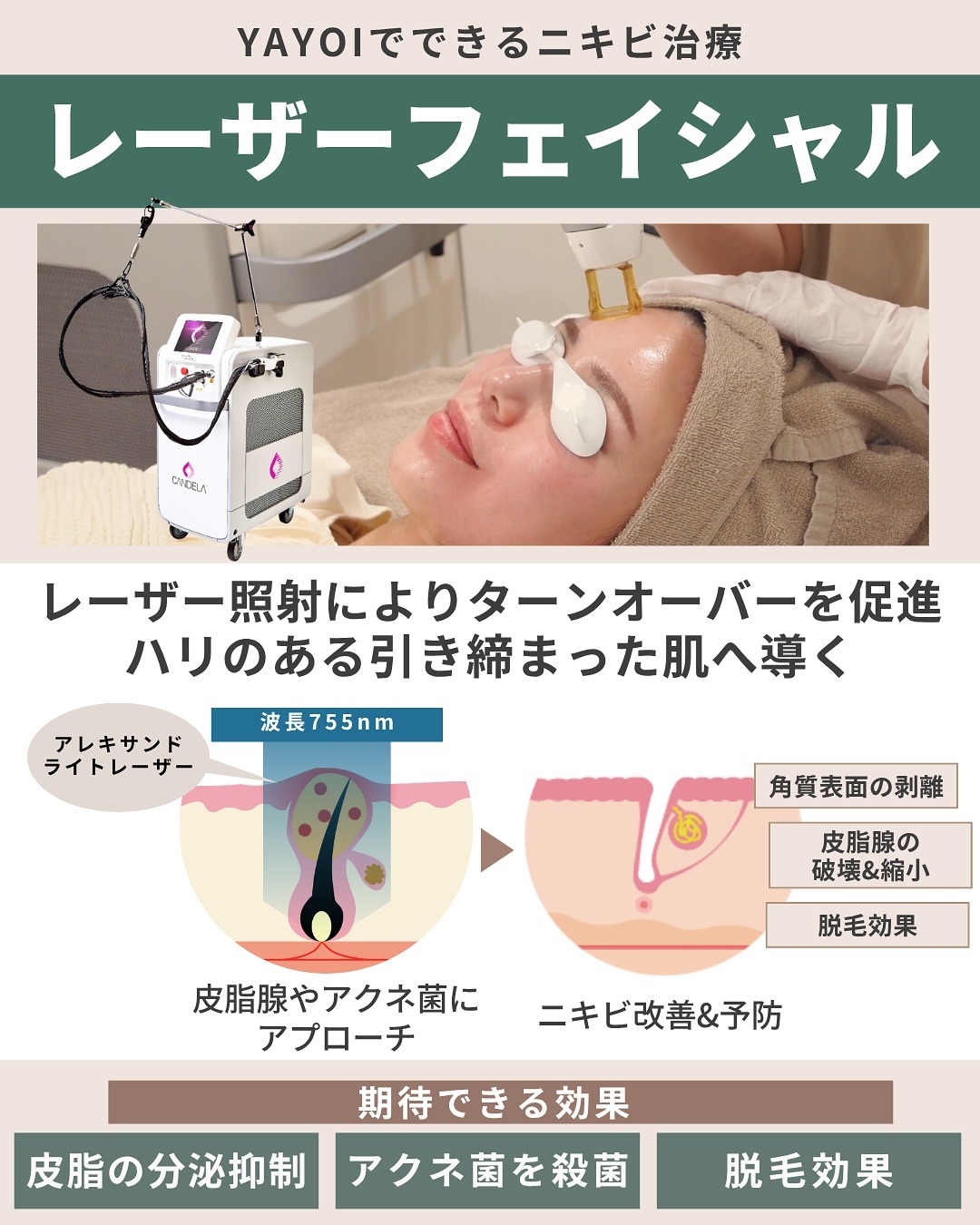 アレキサンドライトレーザーによるニキビ治療