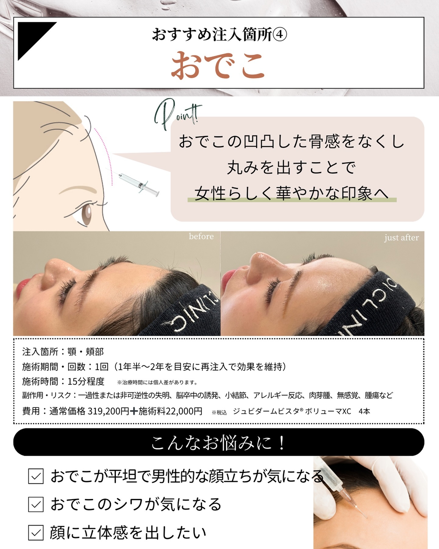 ヒアルロン酸注入 おでこ
