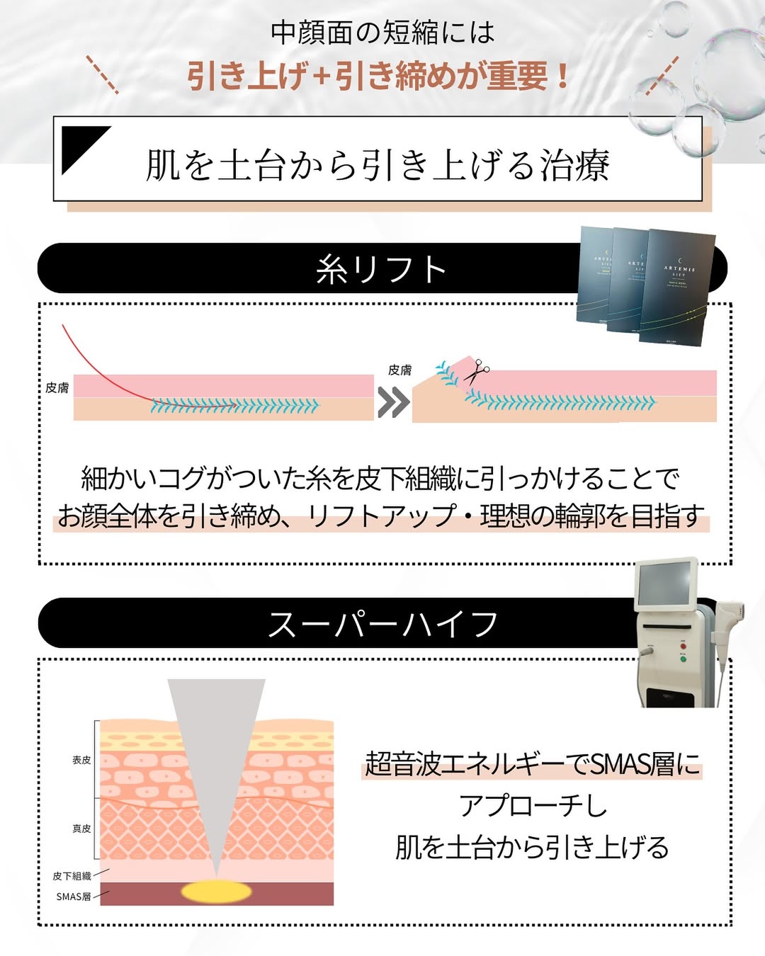 糸リフトとスーパーハイフ