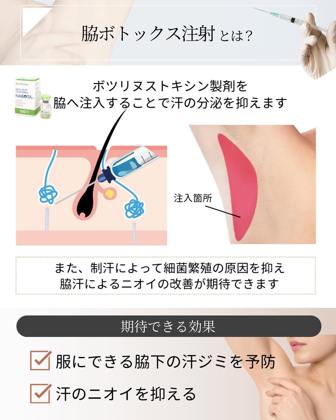 脇ボトックスとは