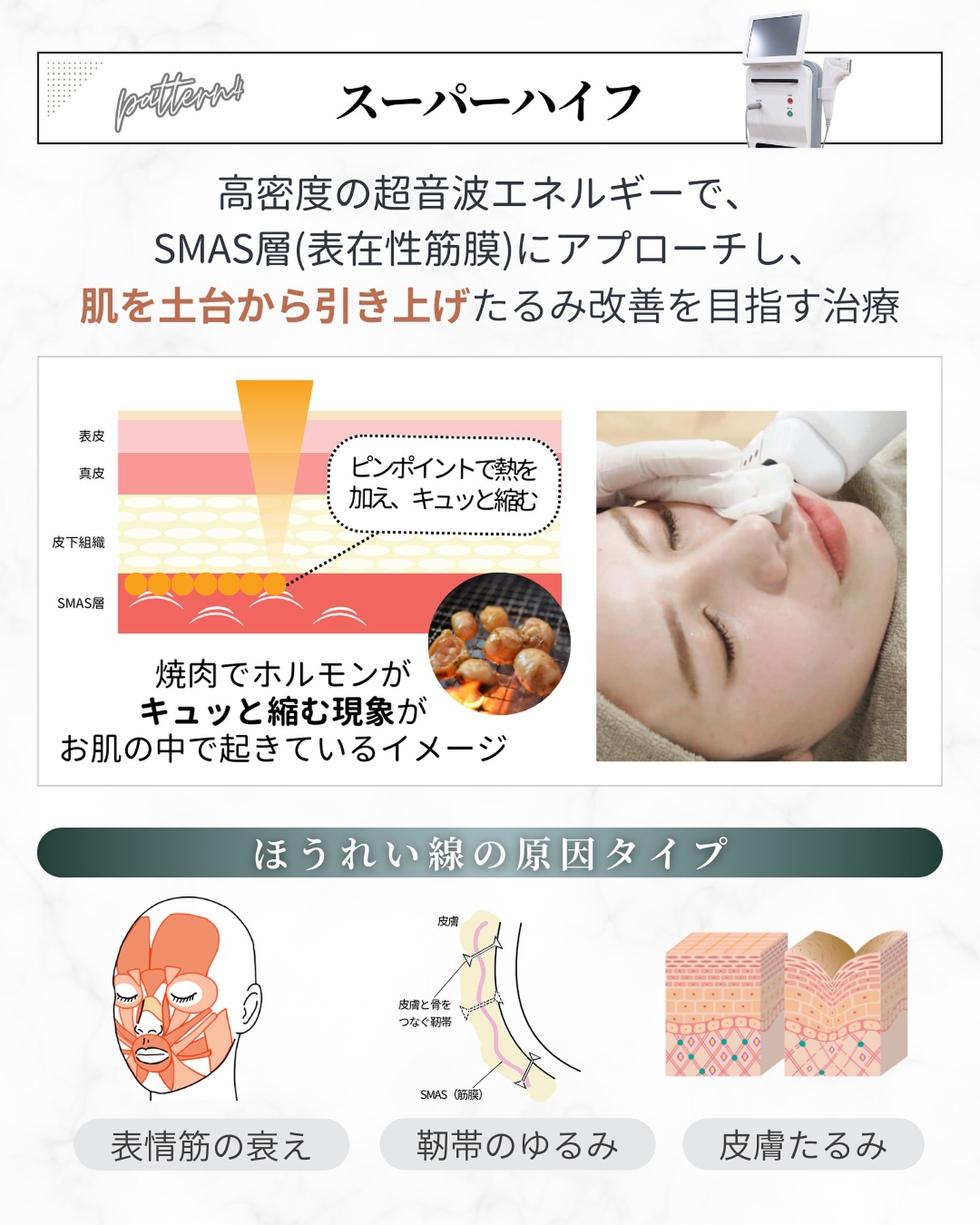 ほうれい線治療「スーパーハイフ」の仕組み