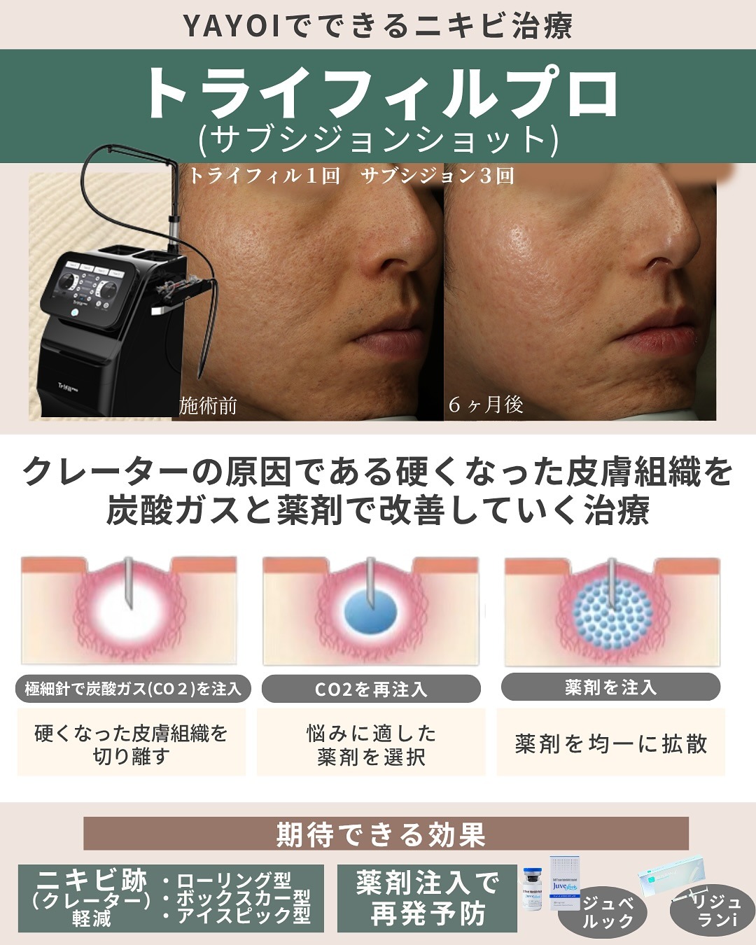 ニキビ痕のクレーター改善・トライフィルプロ