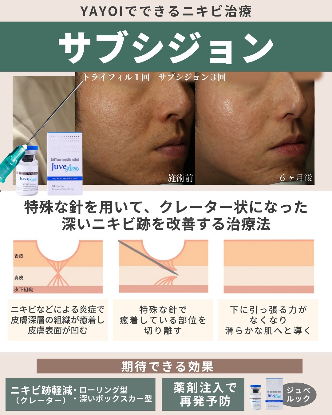 ニキビ痕のクレーター治療・サブシジョン