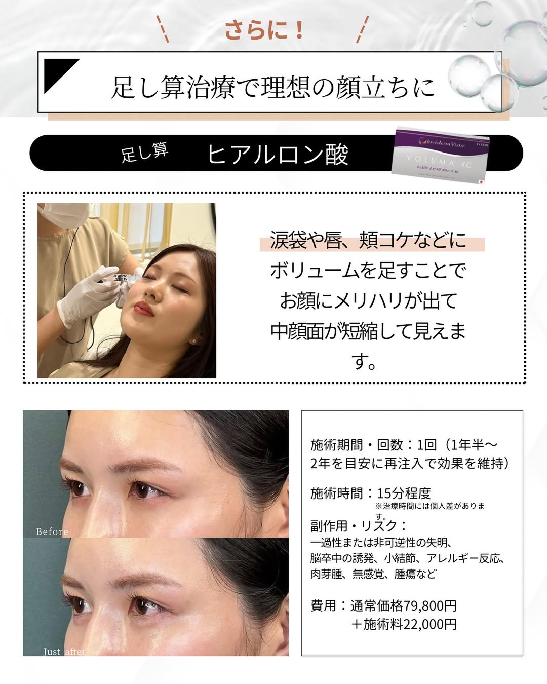 ヒアルロン酸