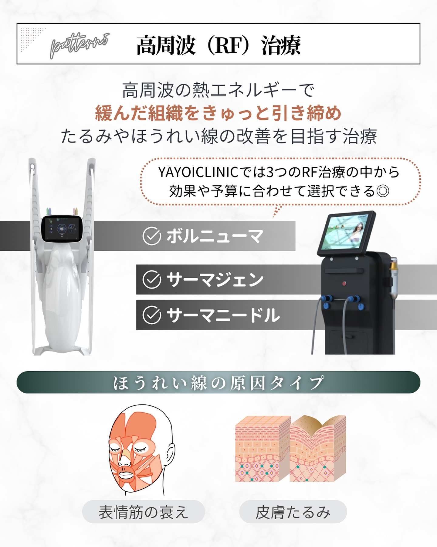 ほうれい線治療「高周波（RF）治療」の仕組みと種類