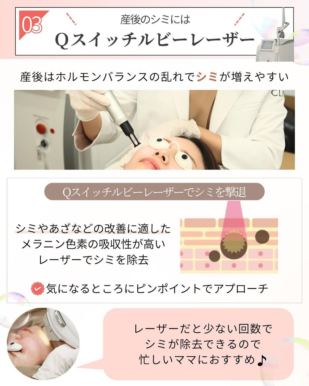 色素沈着にアプローチするQスイッチルビーレーザー