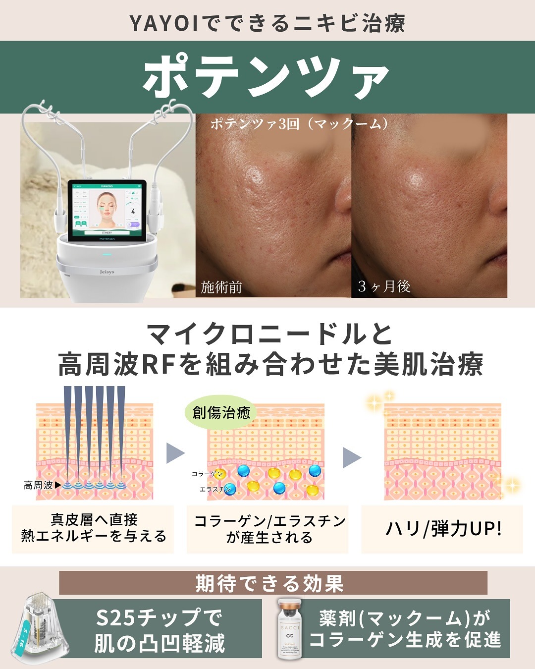 マイクロニードルRF治療のポテンツァ