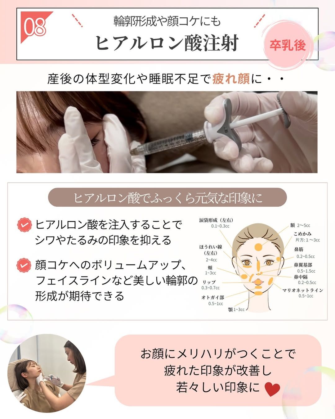 自然なボリュームアップを叶えるヒアルロン酸注射