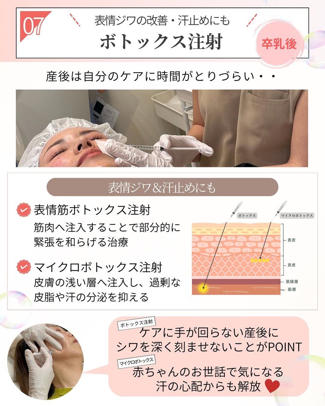 表情ジワの改善や汗止めに効果的なボトックス注射