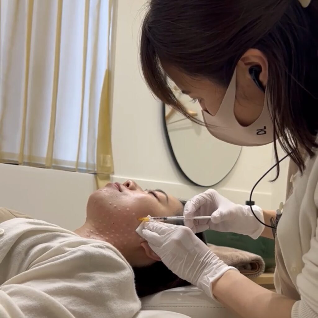 広頚筋ボトックス