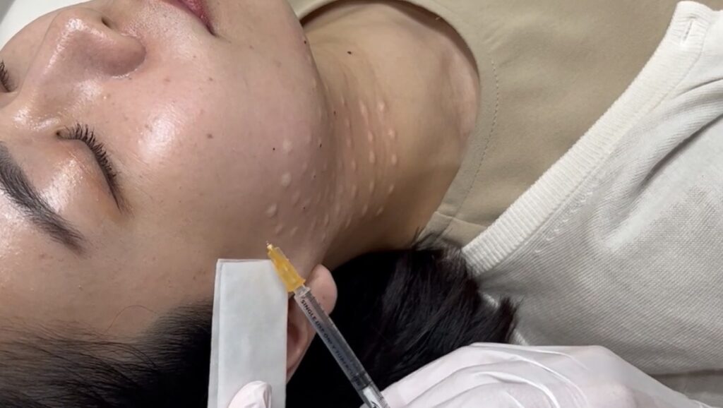 広頚筋ボトックス