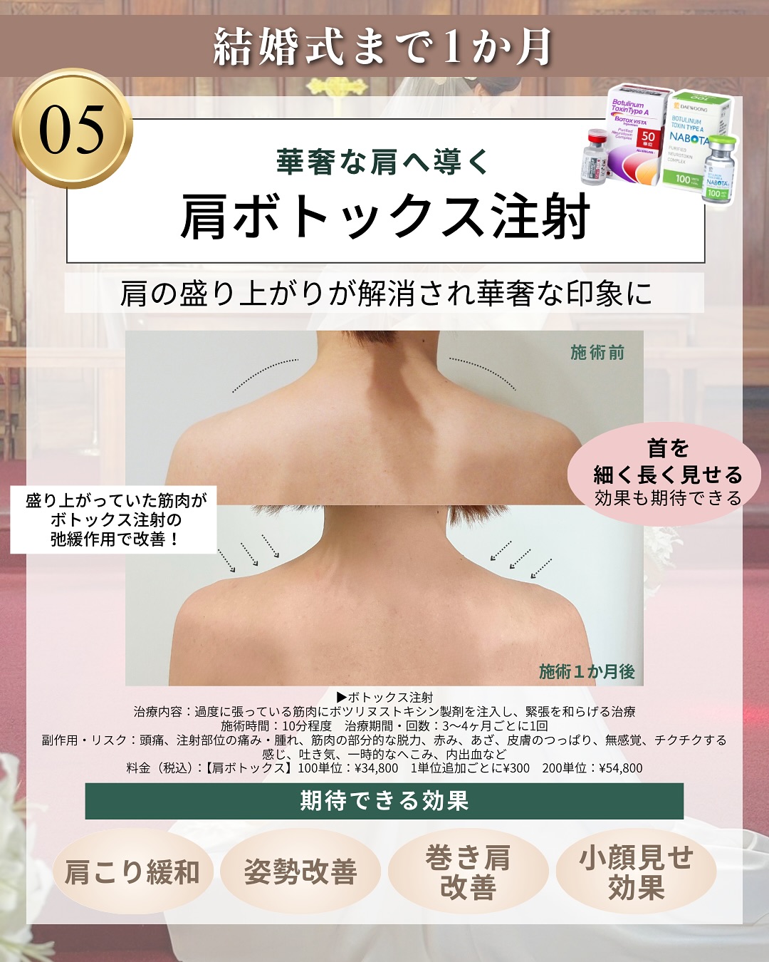肩ボトックス注射