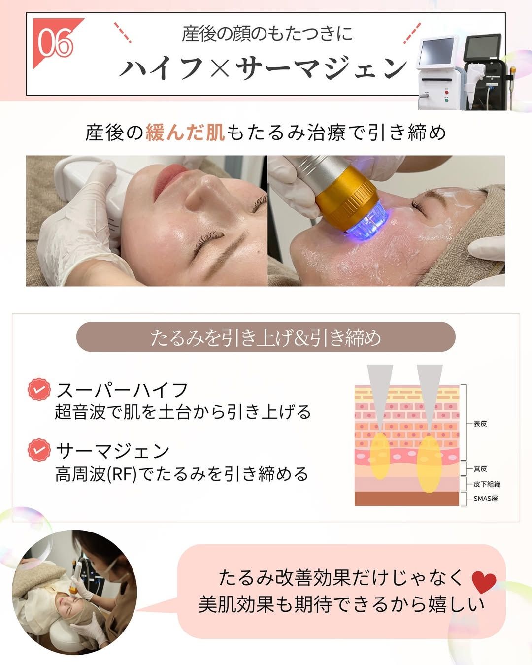 たるみの改善が見込めるハイフ×サーマジェン