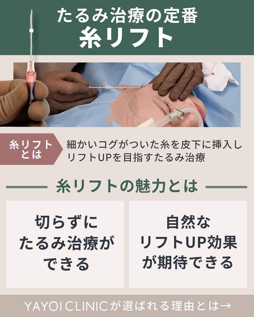糸リフトとは?