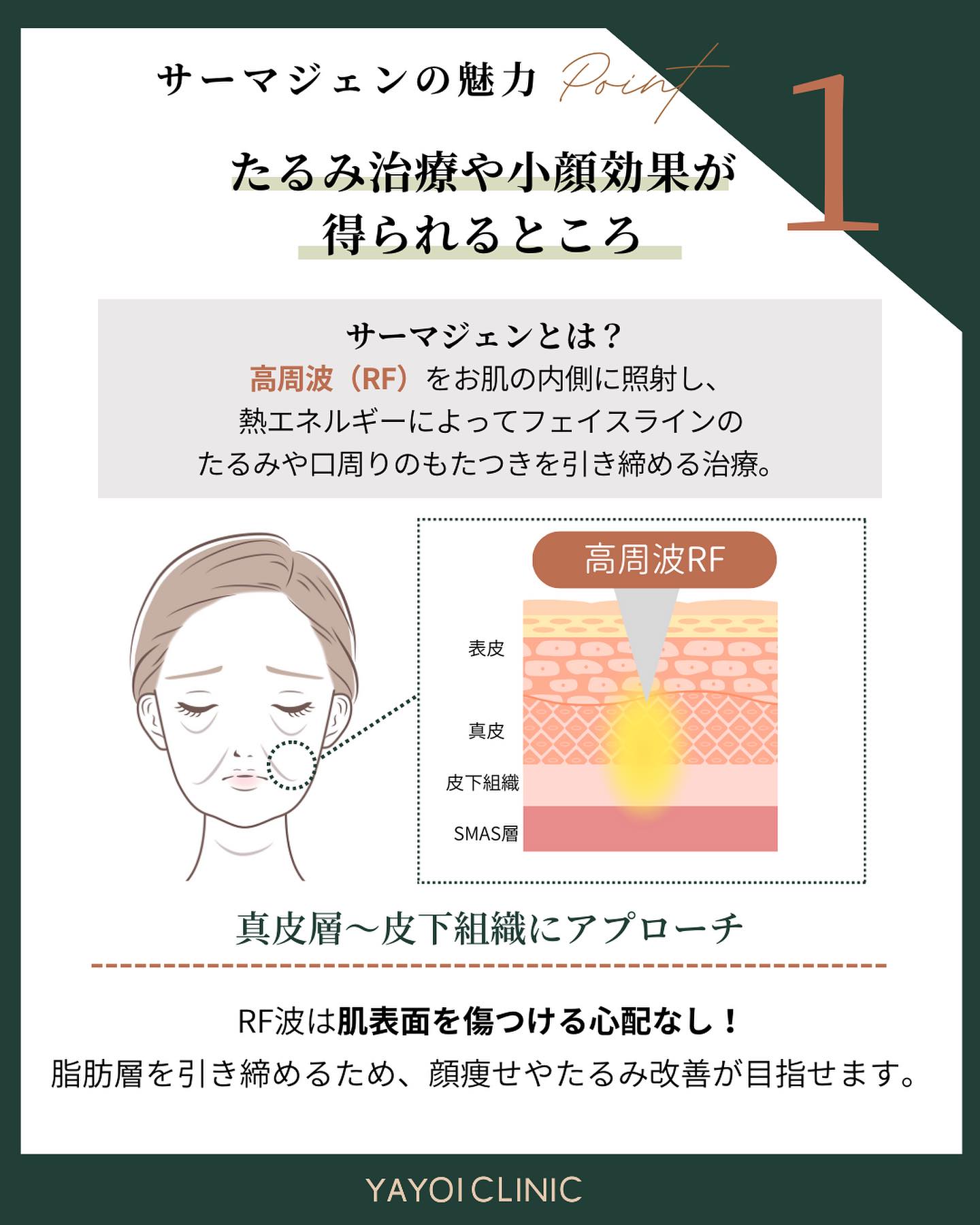 サーマジェンの魅力｜たるみ治療につながる