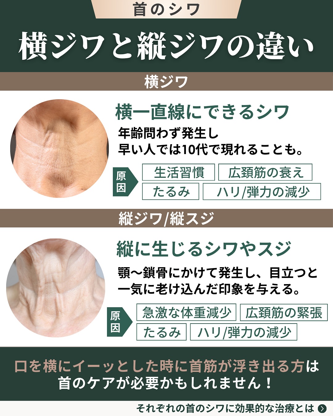 横ジワと縦ジワの違い