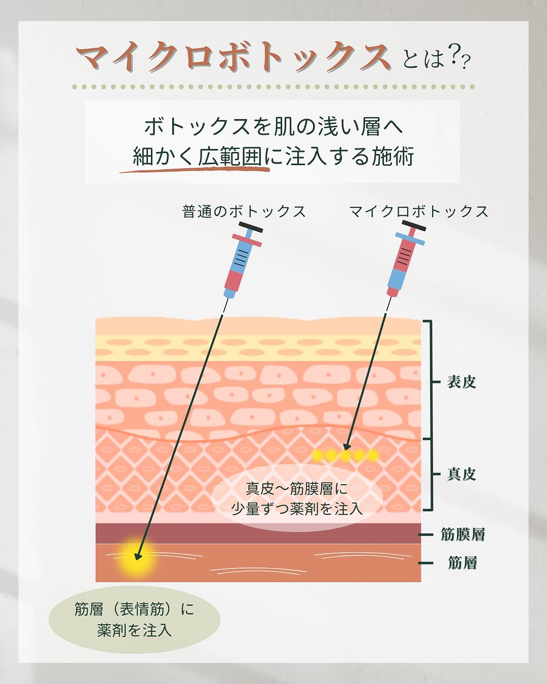 マイクロボトックスとは