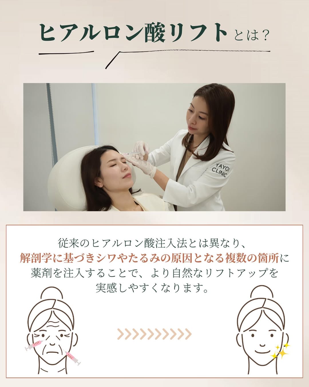 ヒアルロン酸リフトとは?