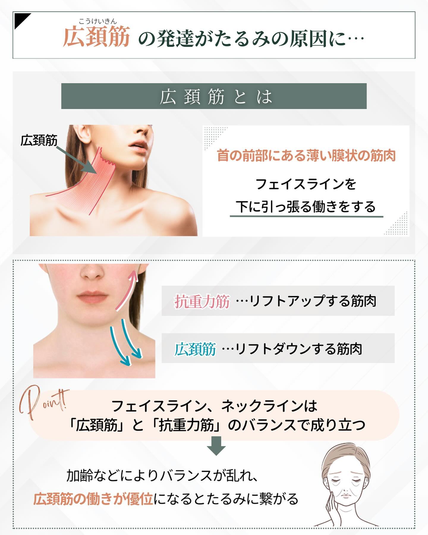 たるみ 原因 広頚筋