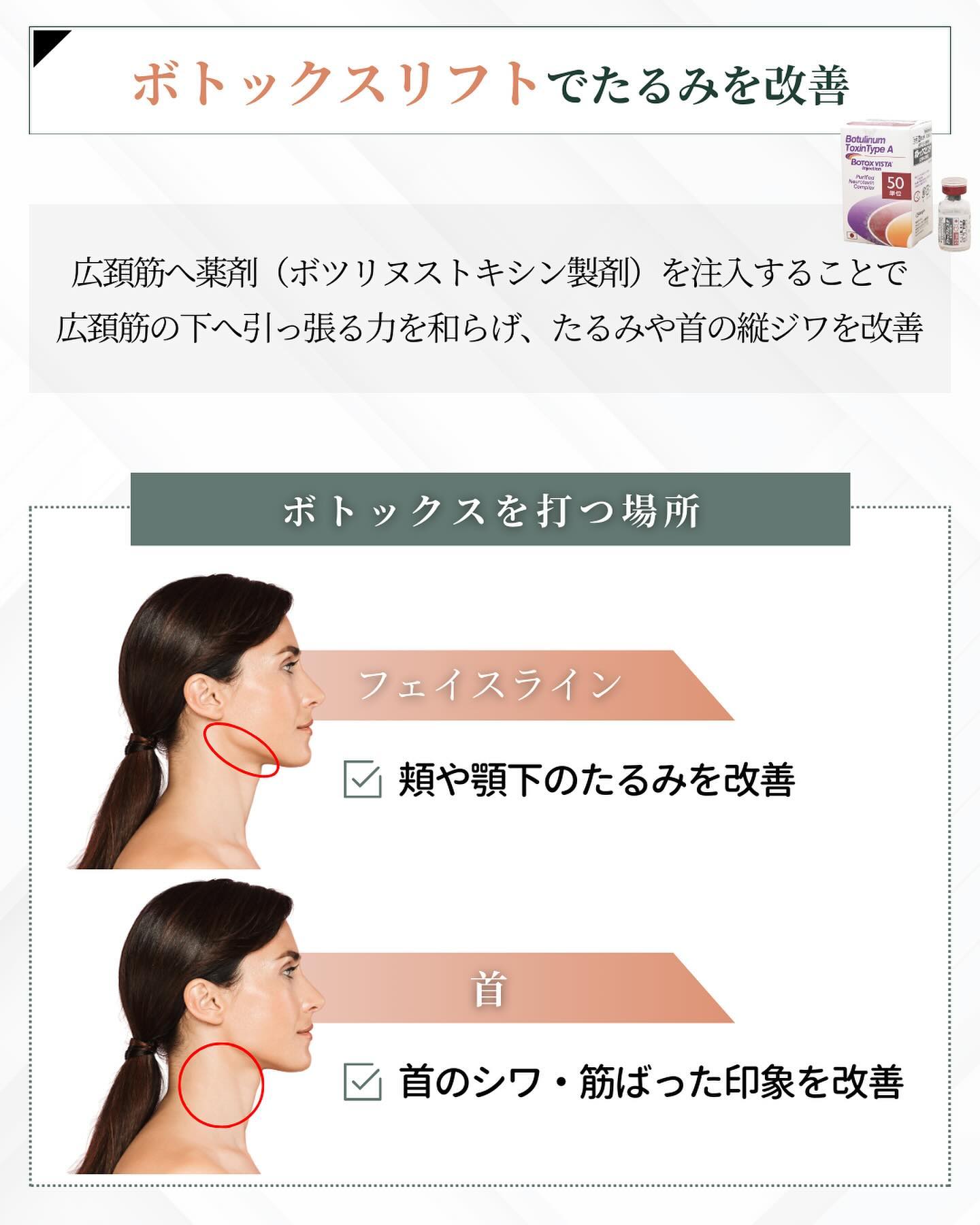 ボトックスリフト たるみ 改善