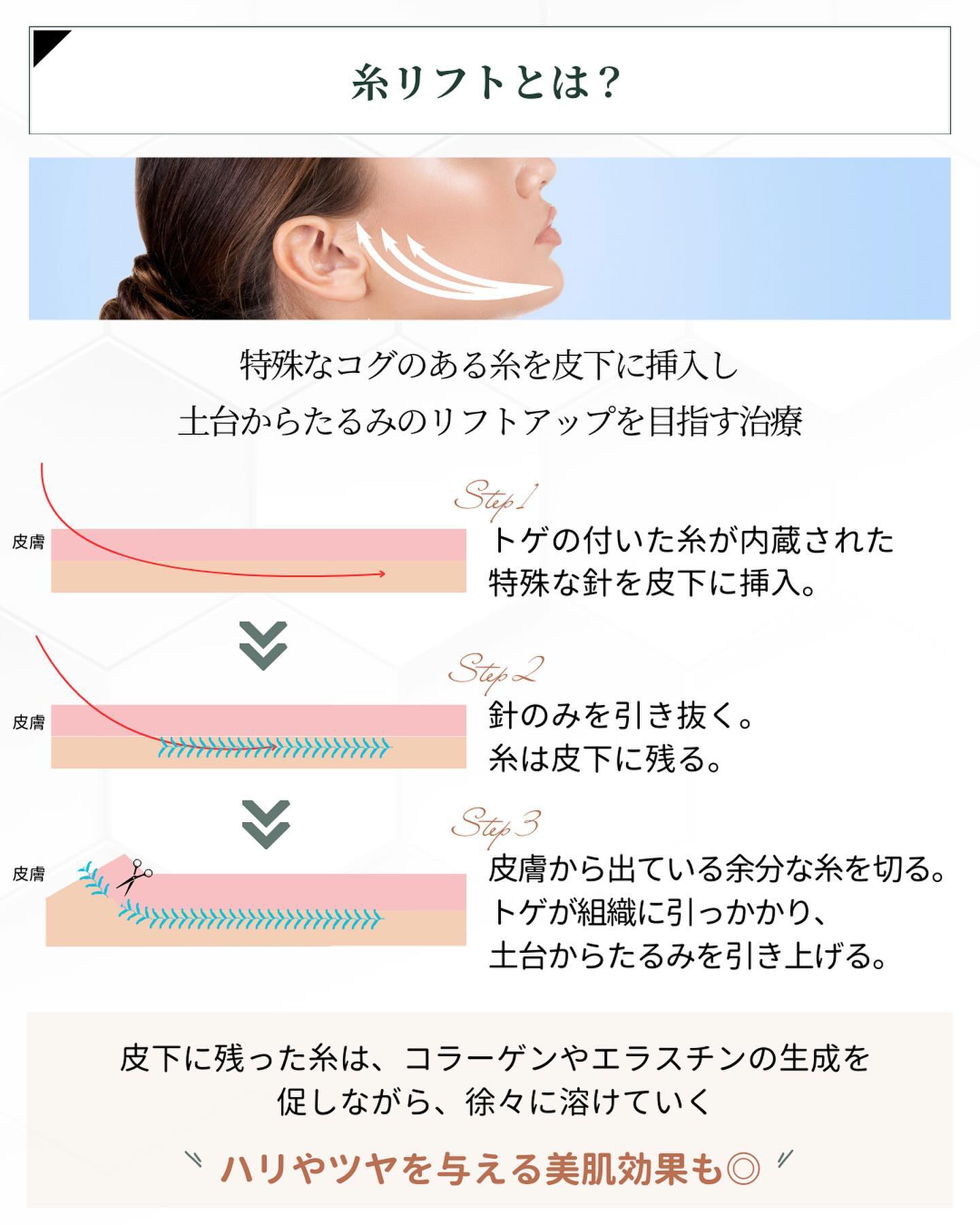 糸リフトとは