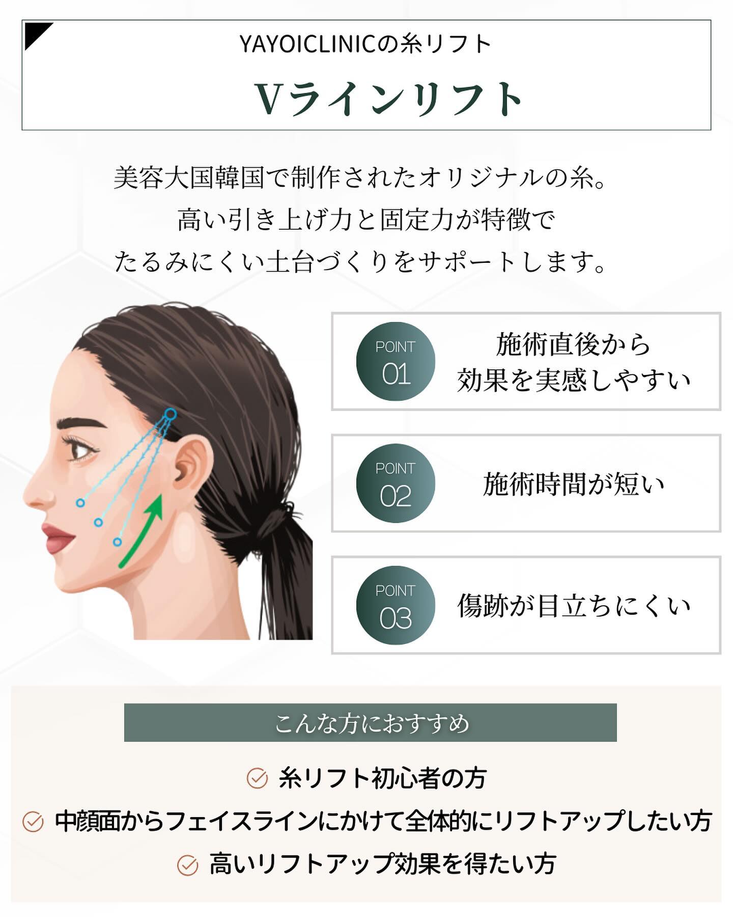 Vラインリフト 特徴