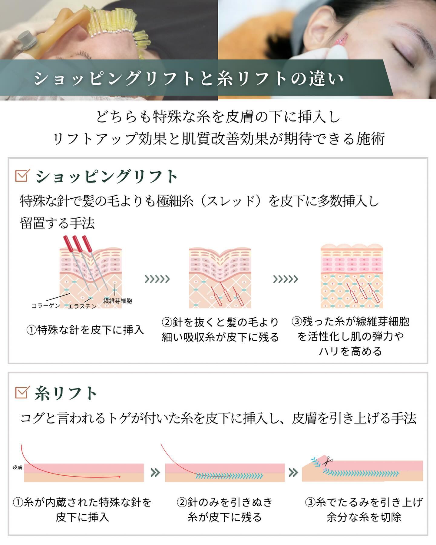 ショッピングリフト 糸リフト 施術内容
