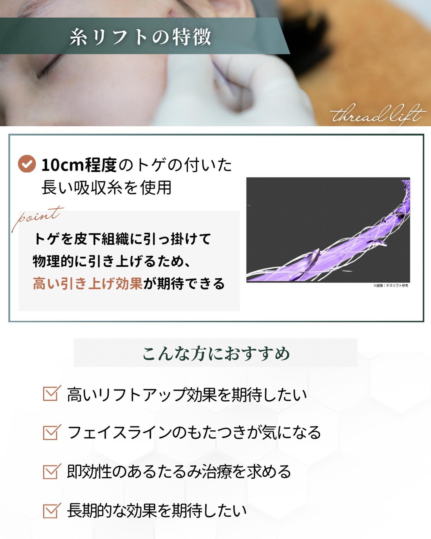 糸リフト 特徴