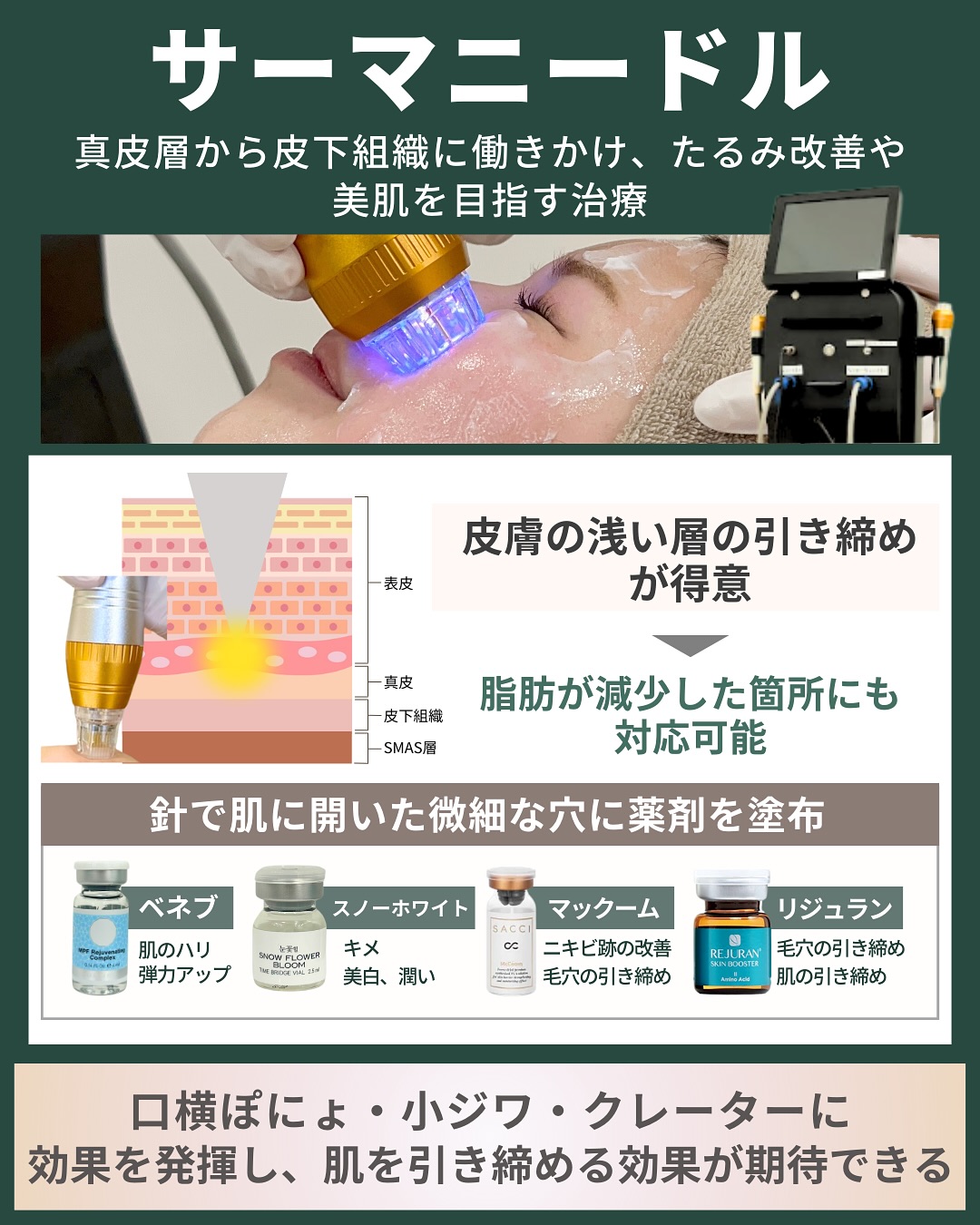 サーマニードル