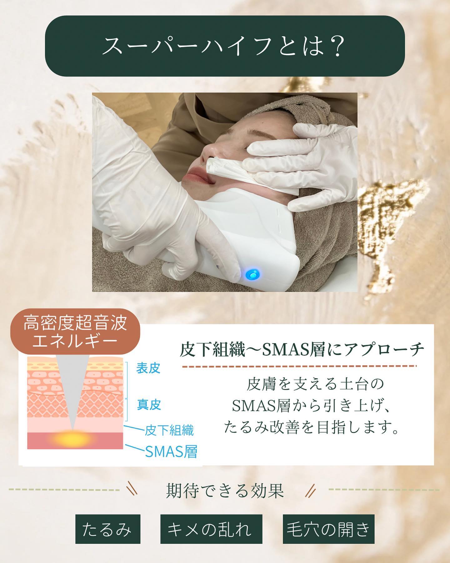 スーパーハイフの仕組みと効果