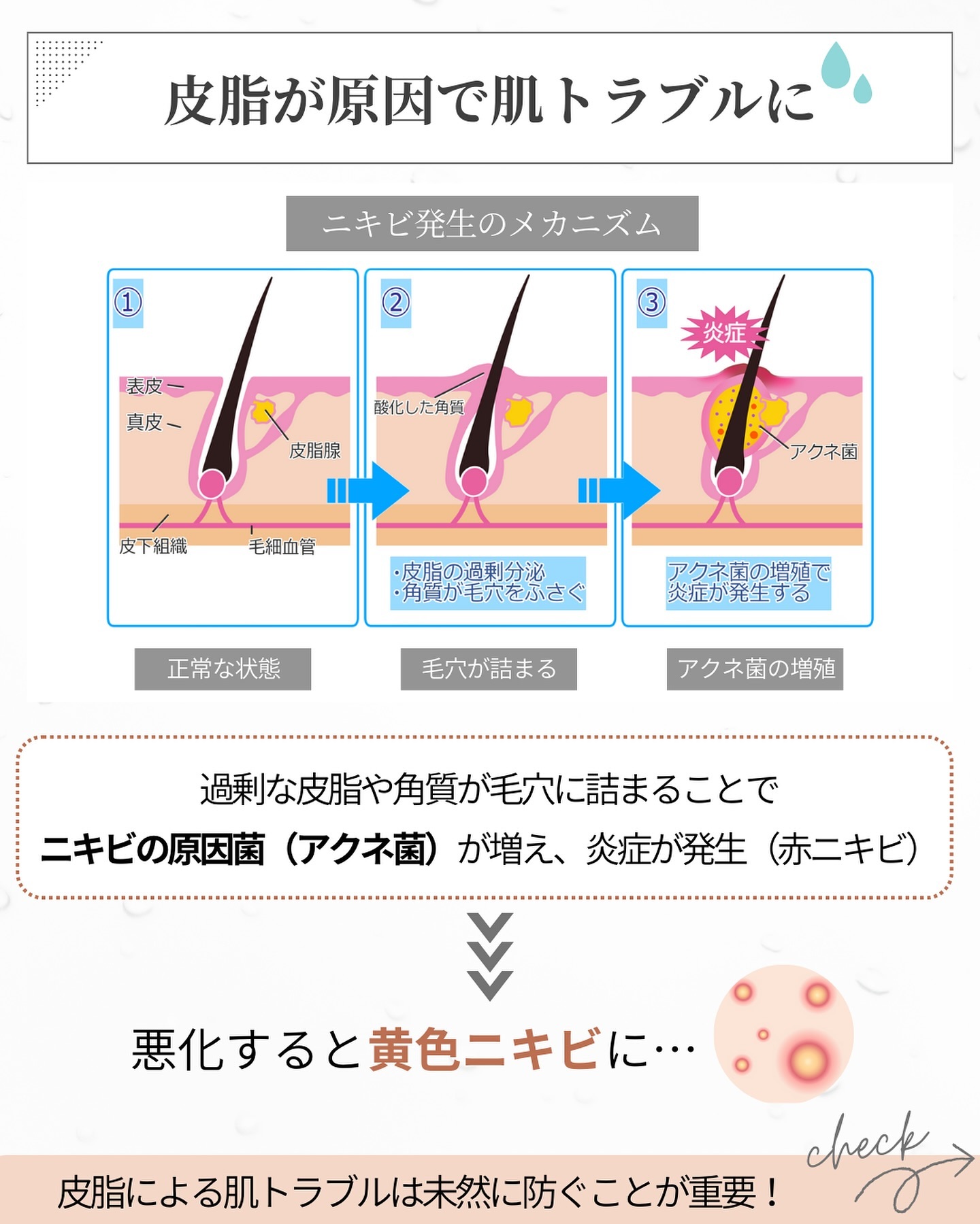 ニキビのメカニズム