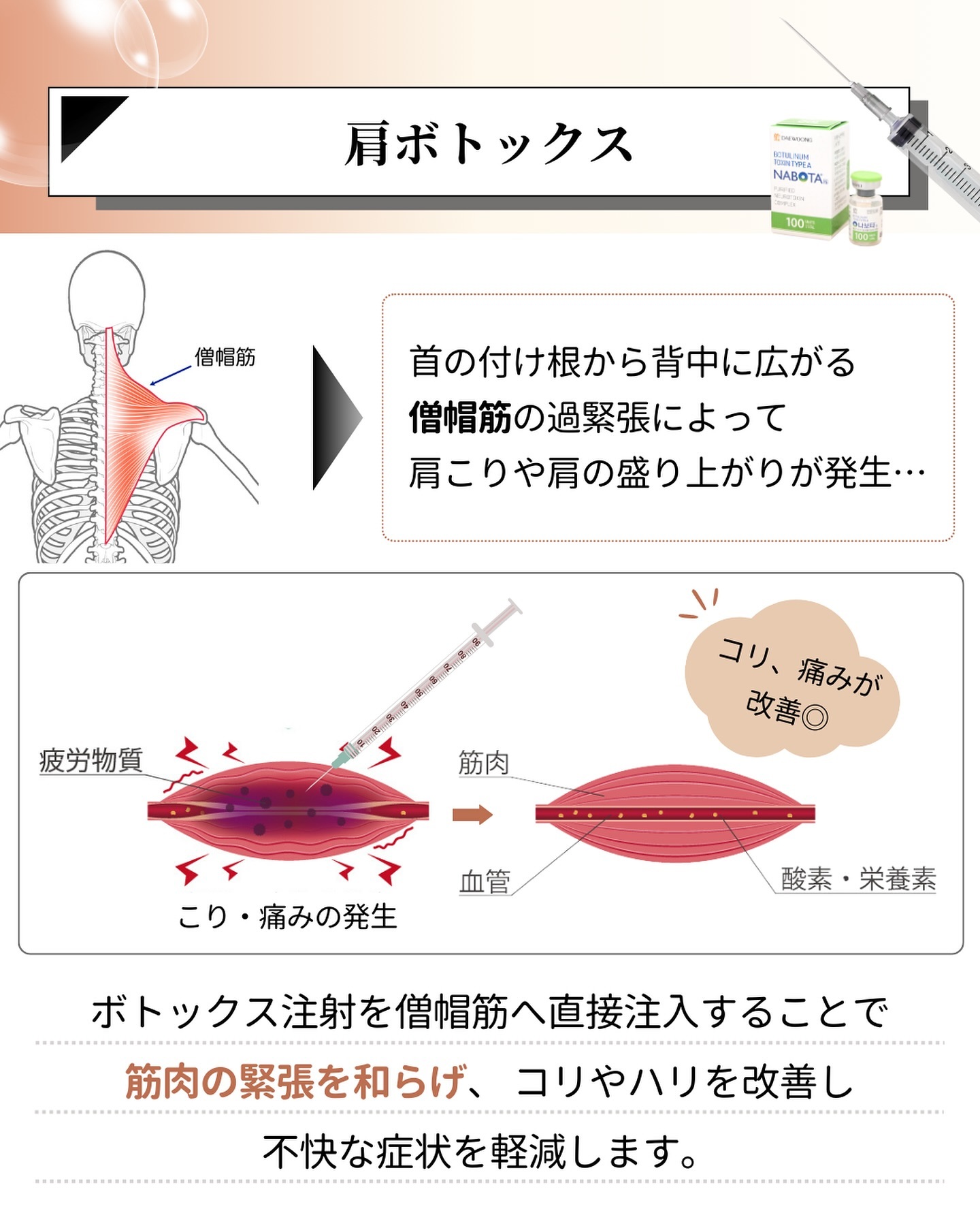 肩ボトックス注射とは