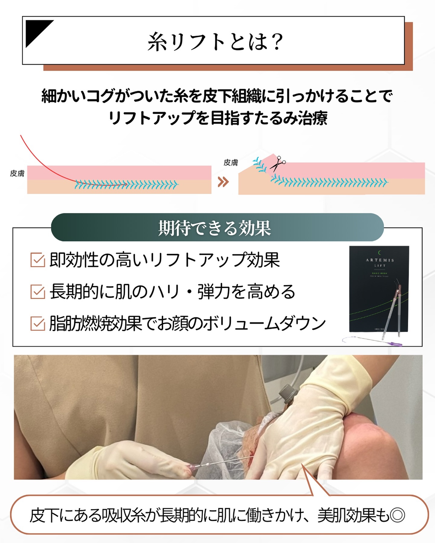 糸リフト　効果