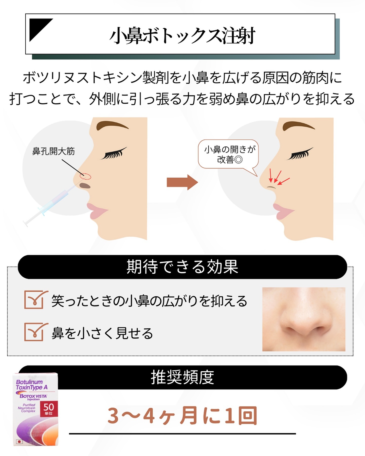 小鼻ボトックス注射