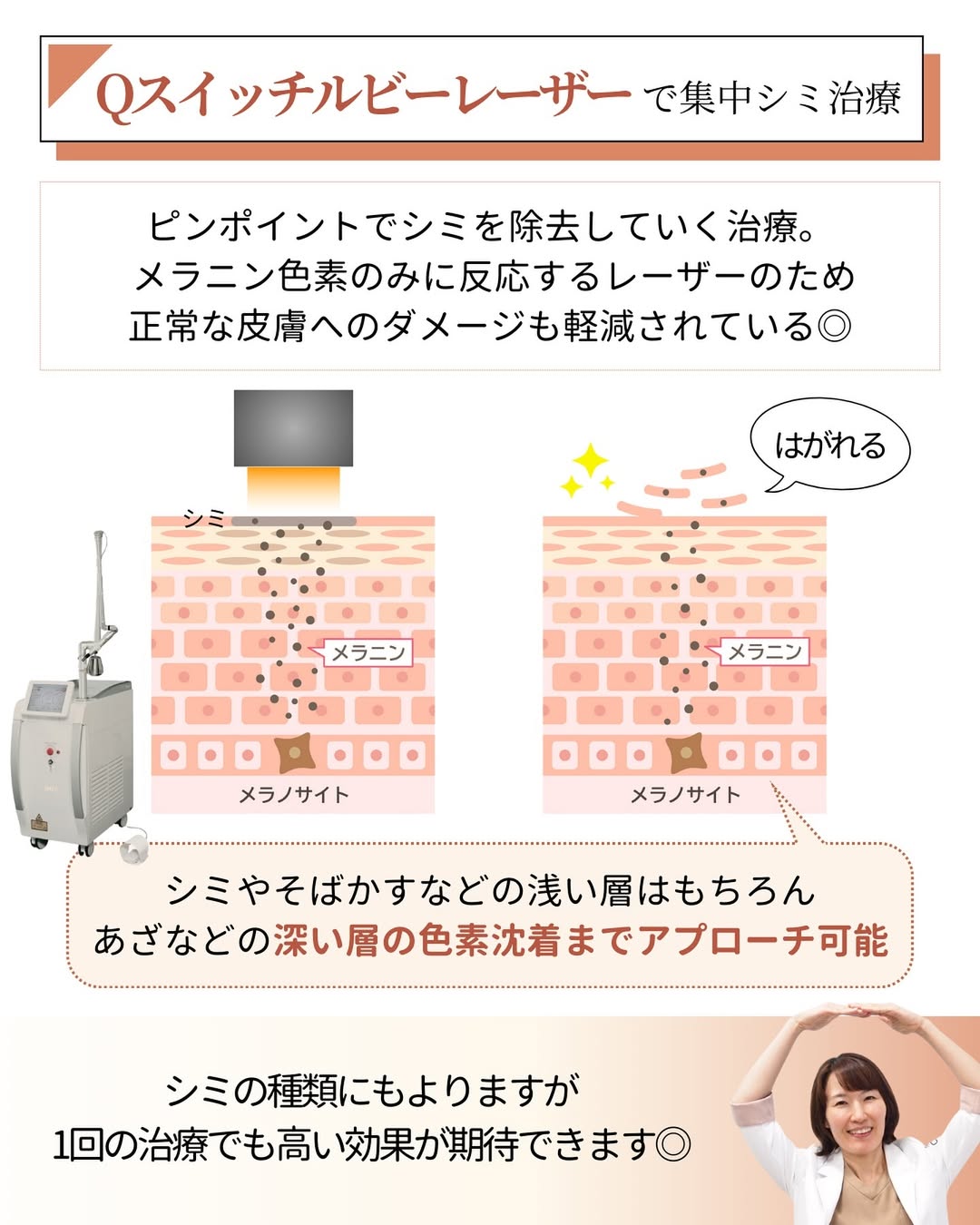 シミ治療Qスイッチルビーレーザー