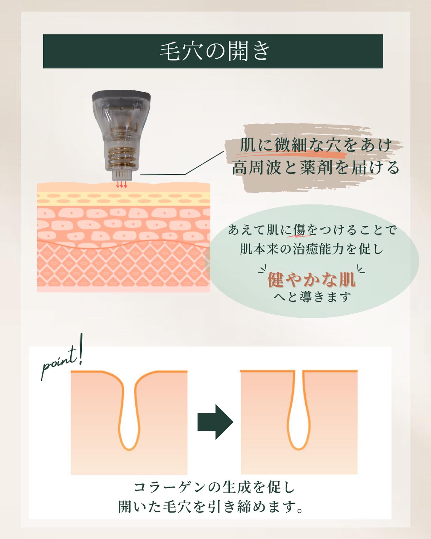 ポテンツァ 毛穴