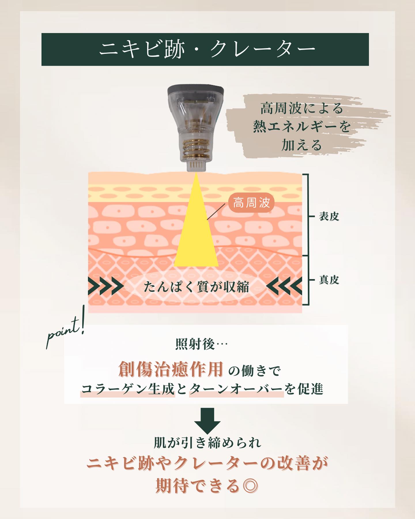 ポテンツァ ニキビ痕 クレーター