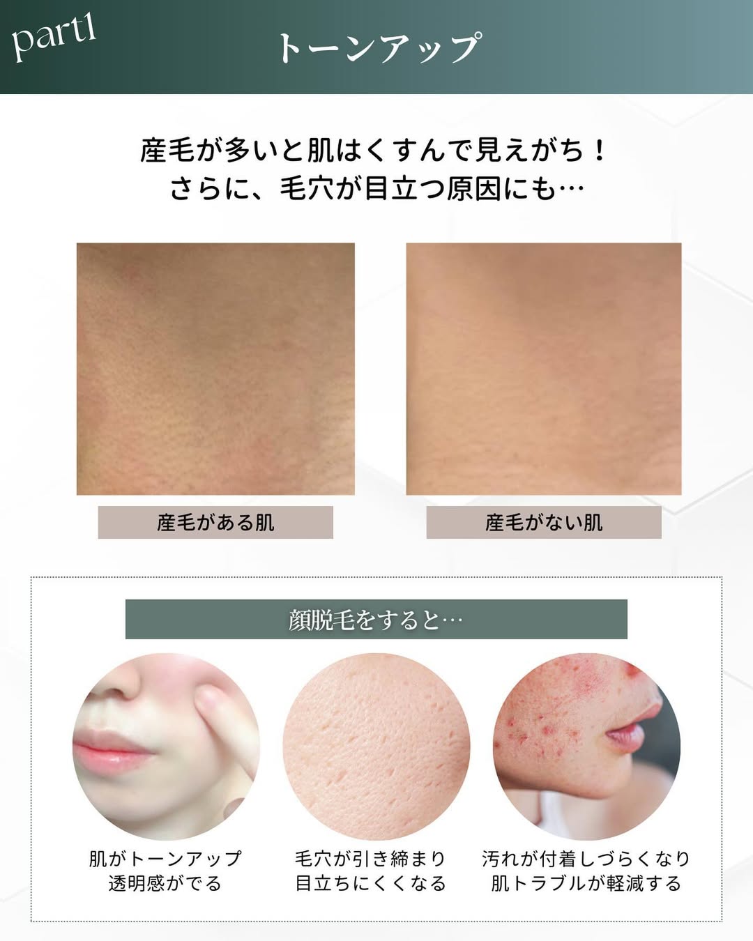顔脱毛 トーンアップ
