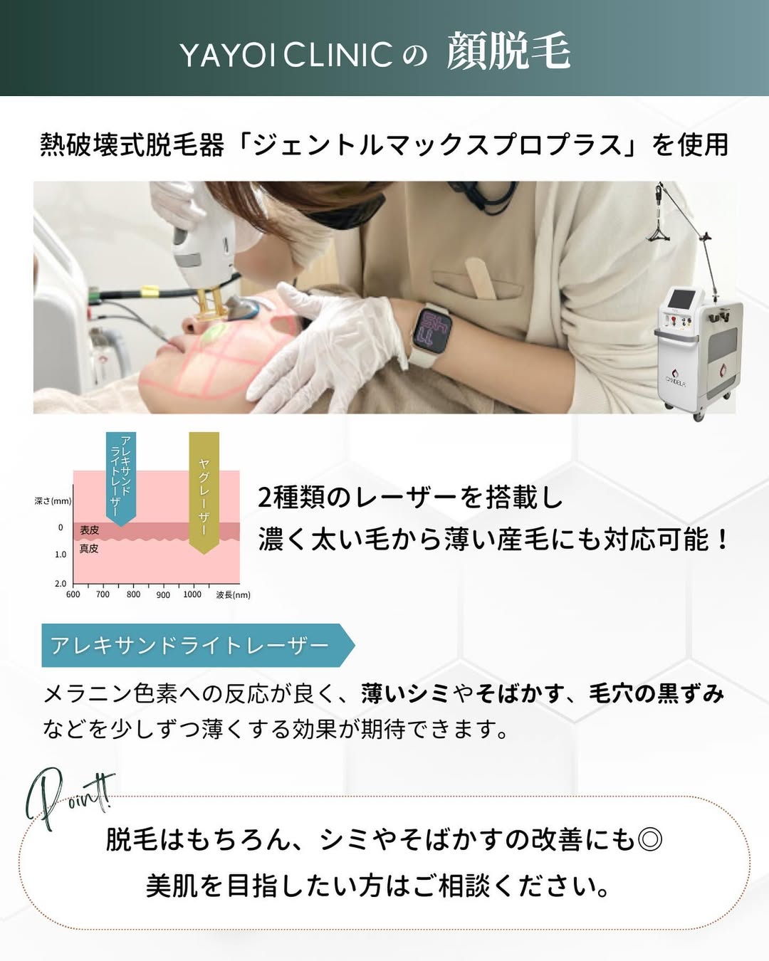 顔脱毛 ジェントルマックスプロプラス