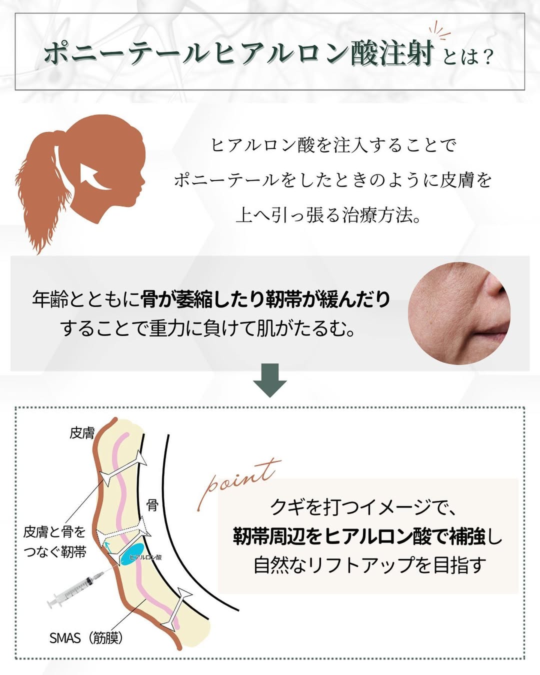 ポニーテール ヒアルロン酸注射