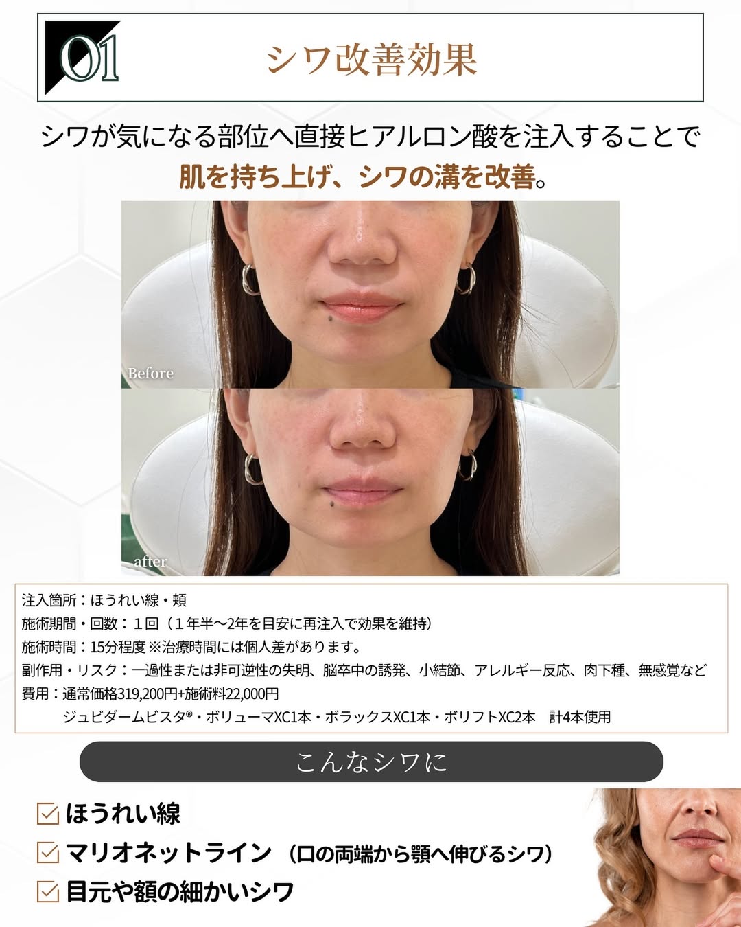 ヒアルロン酸注射 シワへのアプローチ