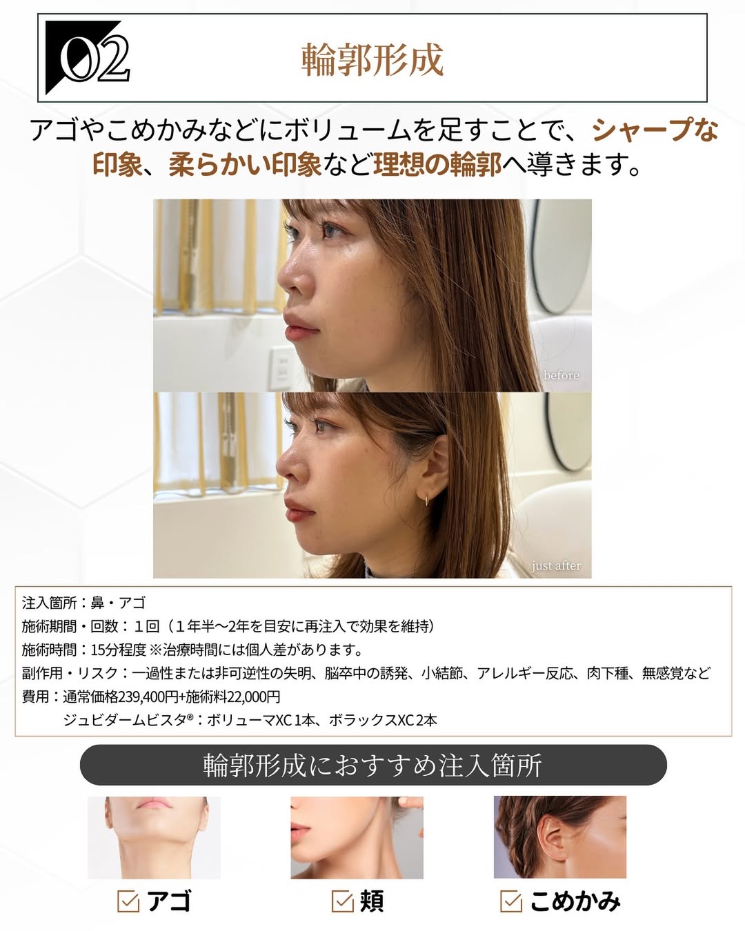 ヒアルロン酸注射 輪郭形成効果