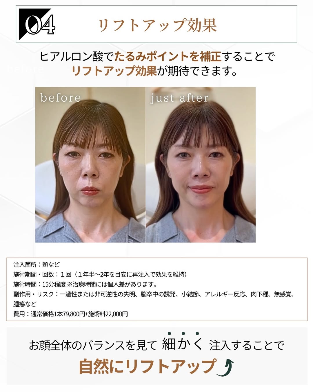ヒアルロン酸注射効果 リフトアップ